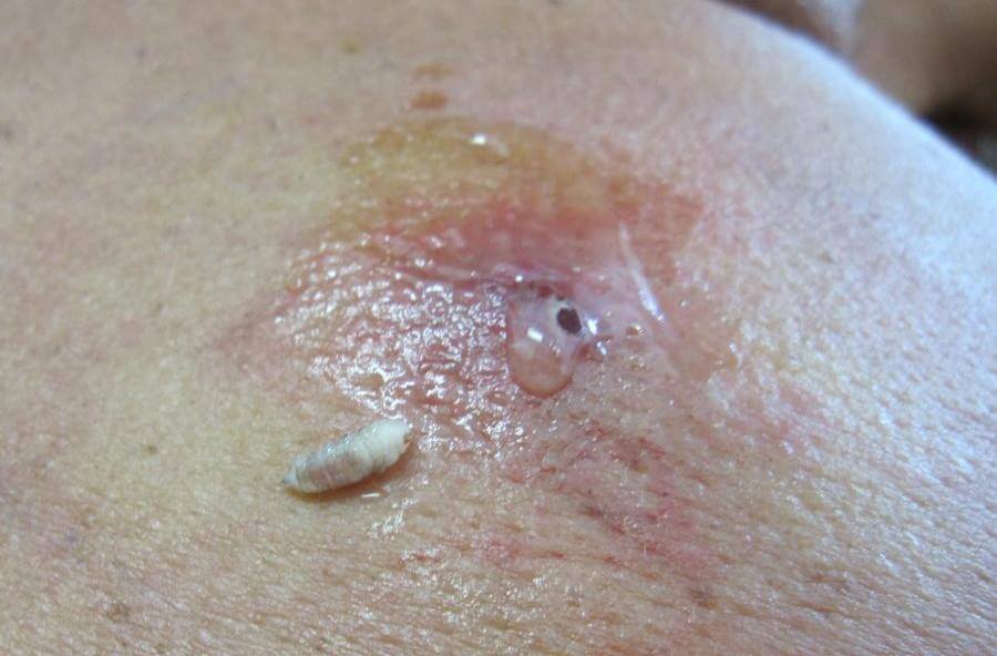 Cutane myiasis - Furunculaire presentatie